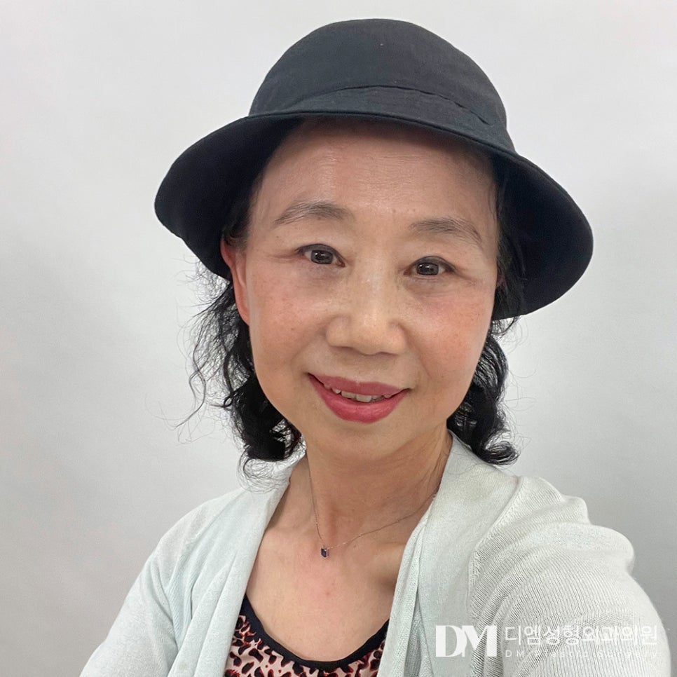 Bulging Under-Eyes Improved with Lower Blepharoplasty for a Clearer Impression! image 1