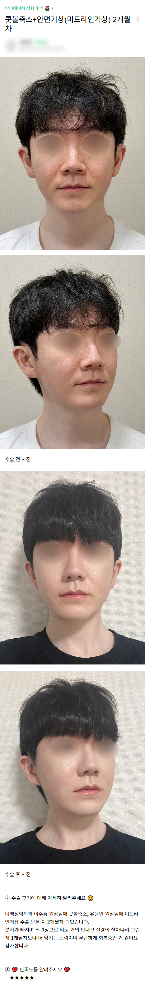 디엠 안면거상/콧볼축소 수술후기, &ldquo;외관상 티도 거의 안 나요!&rdquo; 관련 이미지 1