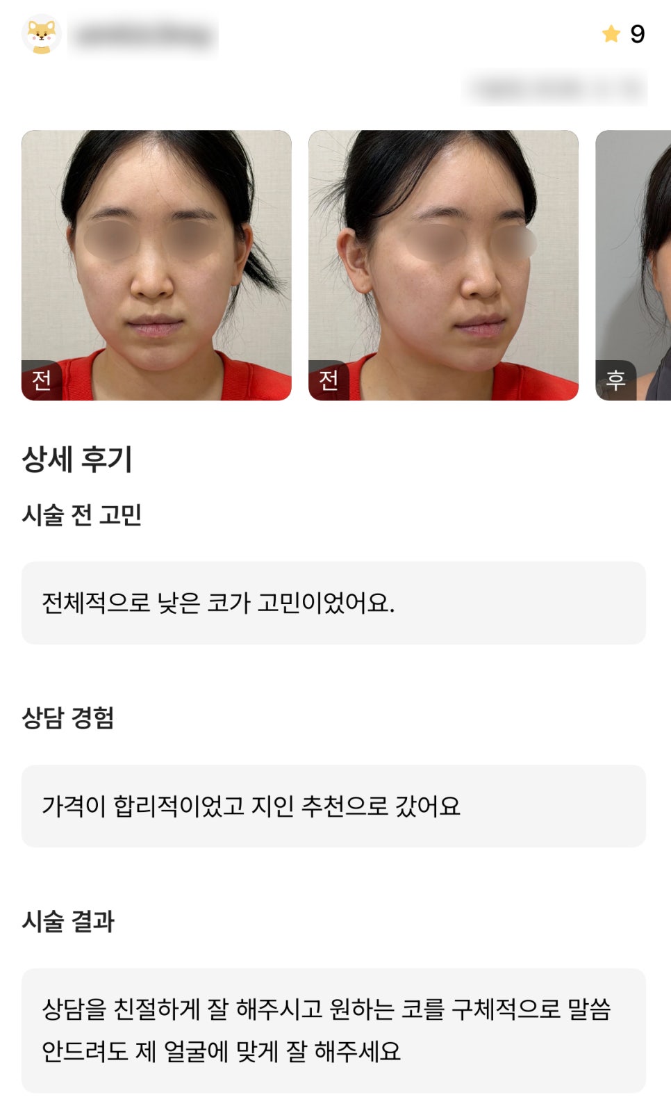 DM Rhinoplasty Review, “They’re kind and do a great job matching my face!” image 1