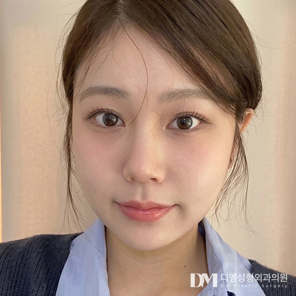 DM Lower Eyelid Fat Repositioning Before & After Photos: Making Deeply Hollow Lower Eyelids Brighter and Smoother! image 3