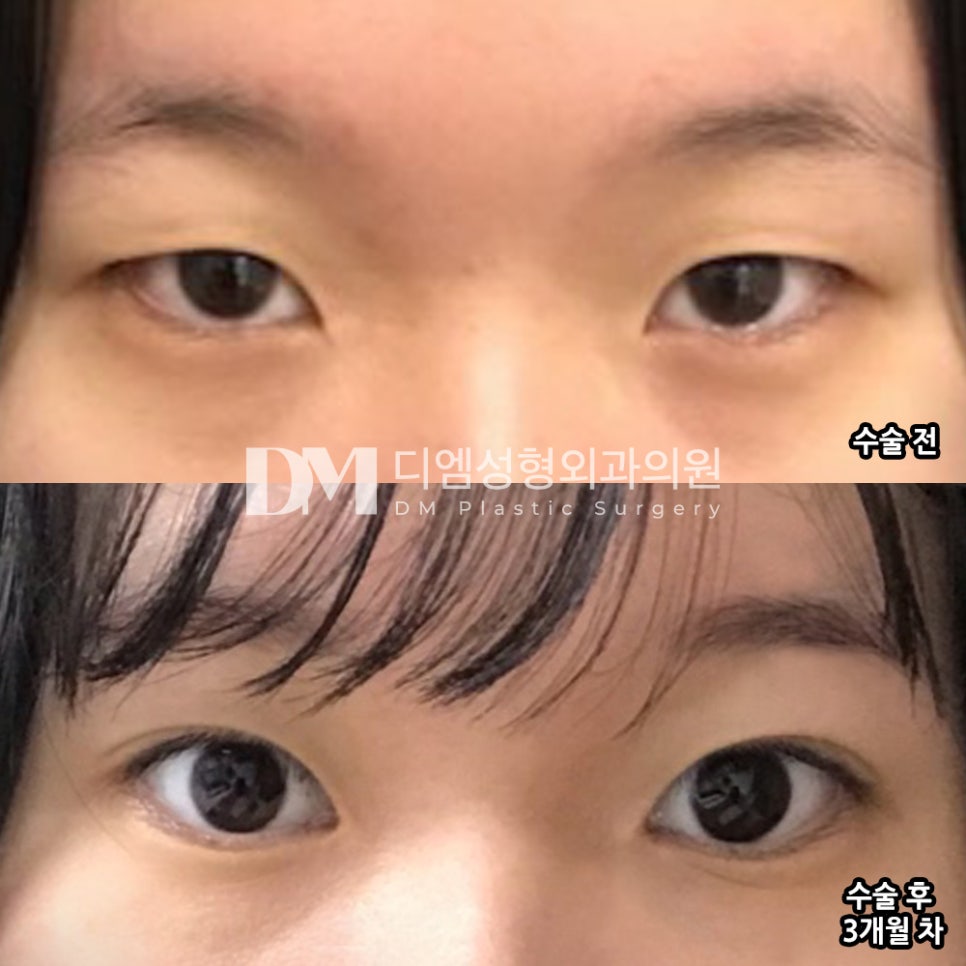 눈성형 후기."주변에서 자연스럽게 잘 됐다고 해서 만족중입니다 😊!" 관련 이미지 2