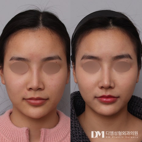 코재수술 , 반복하고 싶지 않다면? 관련 이미지 10