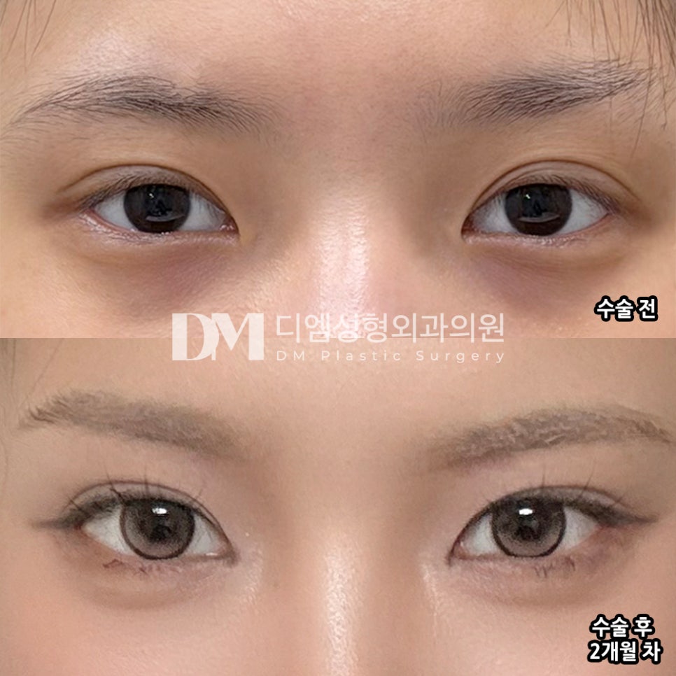 디엠 뒤밑트임/트임성형 후기, &ldquo;수술하길 잘했다는 생각이 들어요!&rdquo; 관련 이미지 2