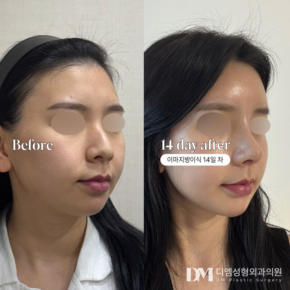 Creating Natural Volume with Facial Fat Grafting image 6