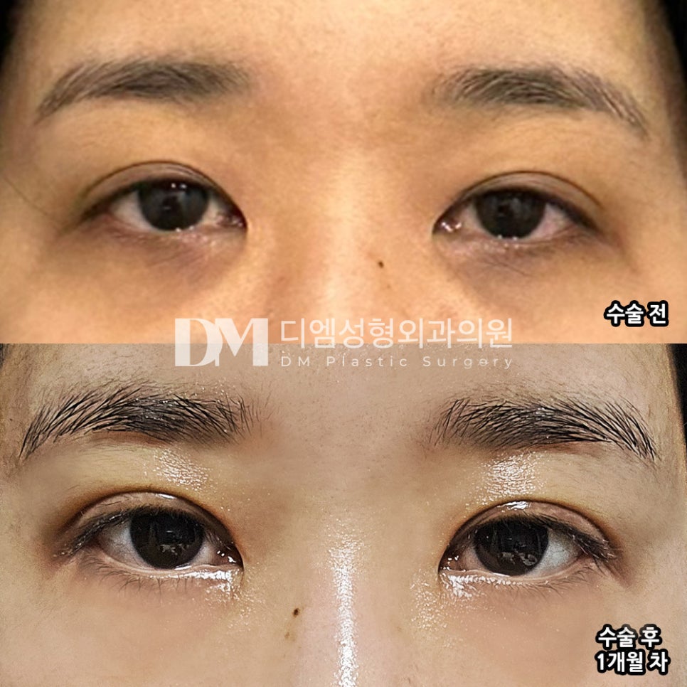 Revision Eyelid Surgery Review: “I’m Satisfied That It Looks Much More Natural!” image 2