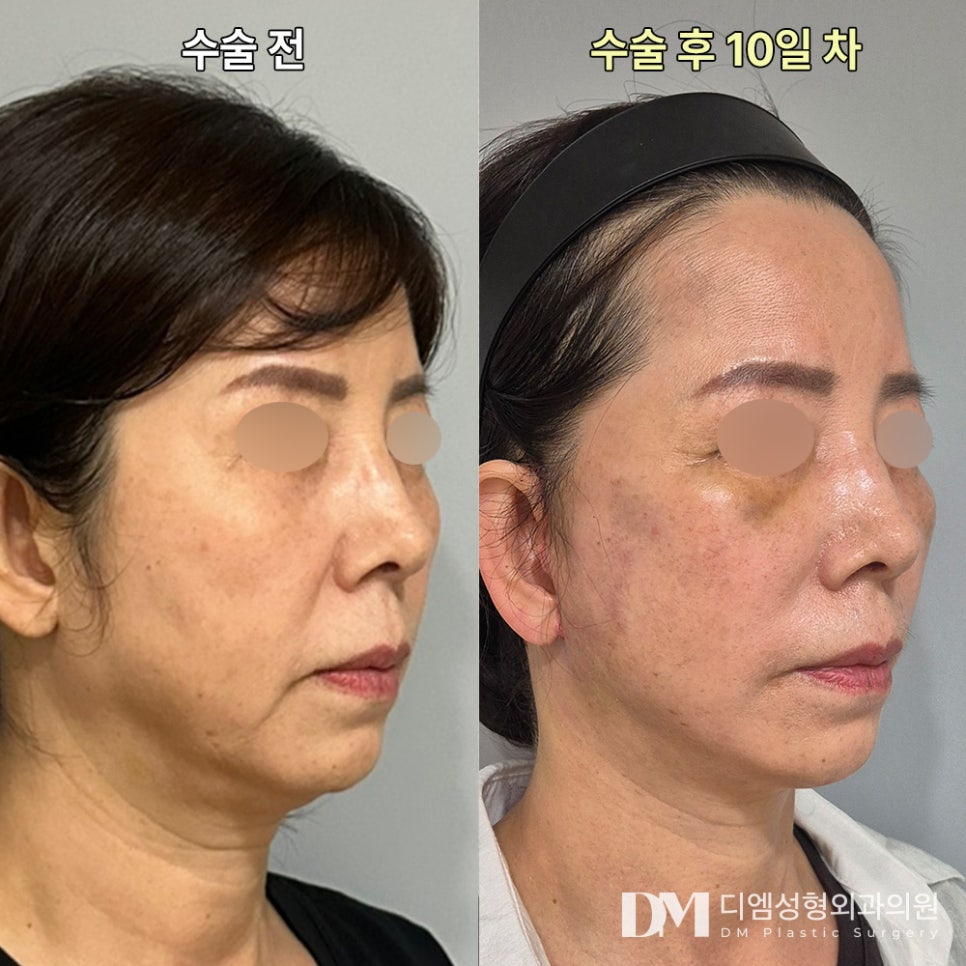 안면거상 후기."눈에 띄게 좋아져 아주 만족해요!" 관련 이미지 2