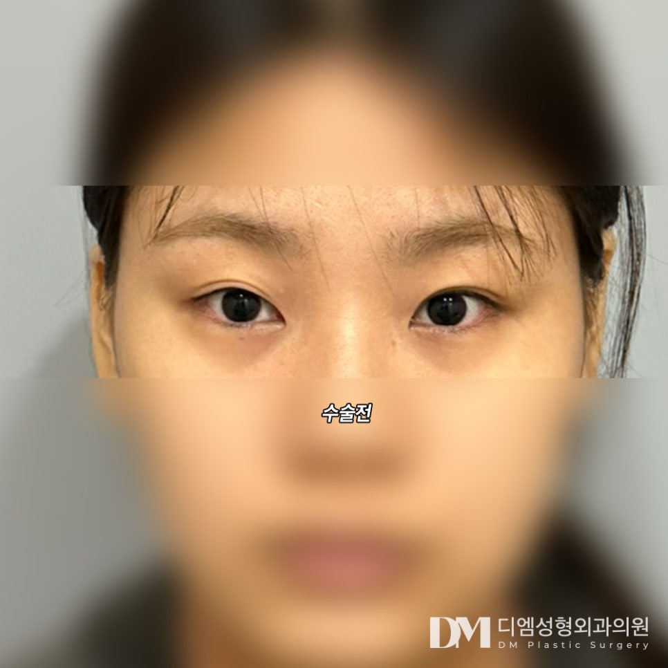 Revision Eyelid Surgery: Identifying the Exact Cause of Failure Is Important! image 8