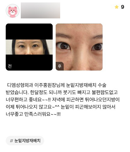Under-Eye Fat Repositioning Review: “I’m so happy and satisfied that my under-eyes no longer look tired~~!!” image 1