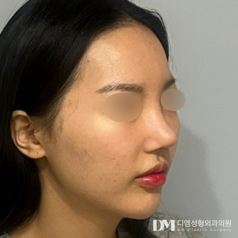 얼굴지방이식 후기."피곤한 인상이 좋아져서 만족이에요!" 관련 이미지 2