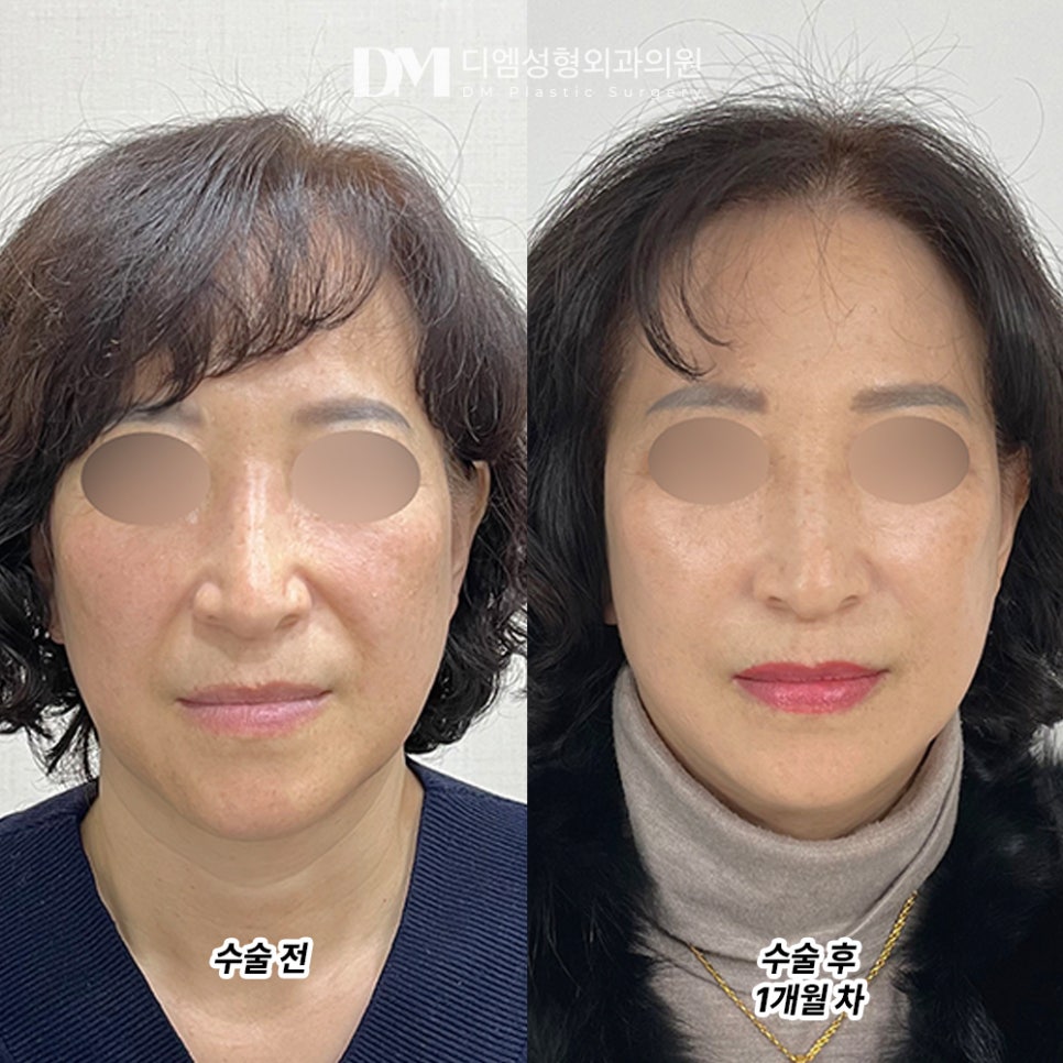 디엠 안면거상 전후사진, 잃어버린 자신감과 탄력 되찾기! 관련 이미지 2