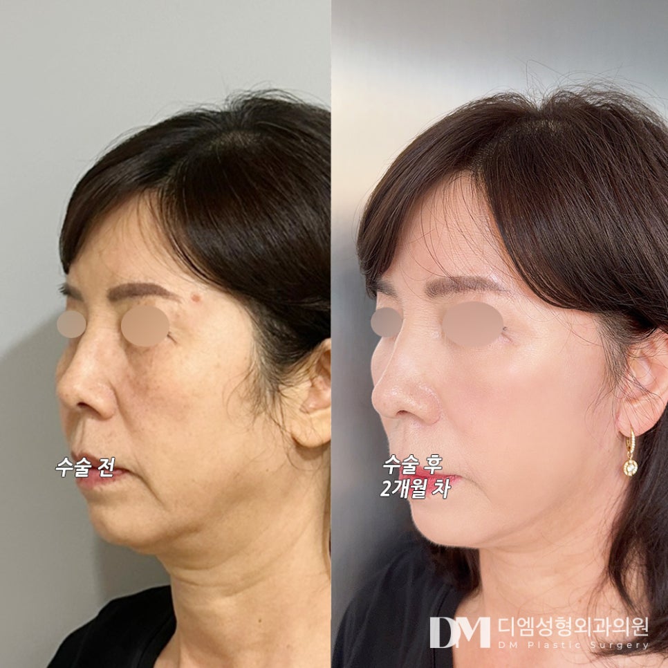 안면거상 후기."꼼꼼하게 해주셨고 너무 만족스러워요!" 관련 이미지 2