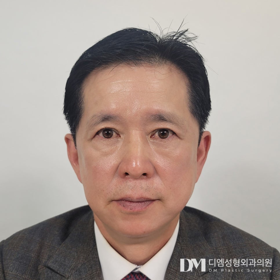 Lower Blepharoplasty: Improving Under-Eye Fat Caused by Aging image 1