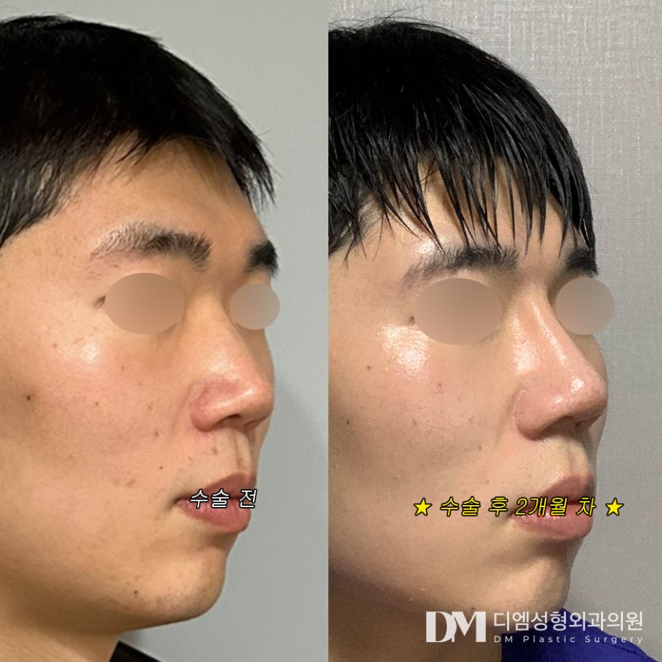 Lower Nose Surgery, the Secret to Improving a Flat Impression! image 8