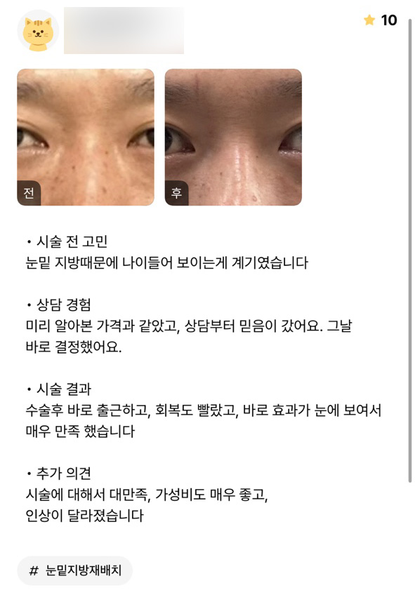 눈밑지방재배치 후기."바로 효과가 보여서 매우 만족입니다!" 관련 이미지 1