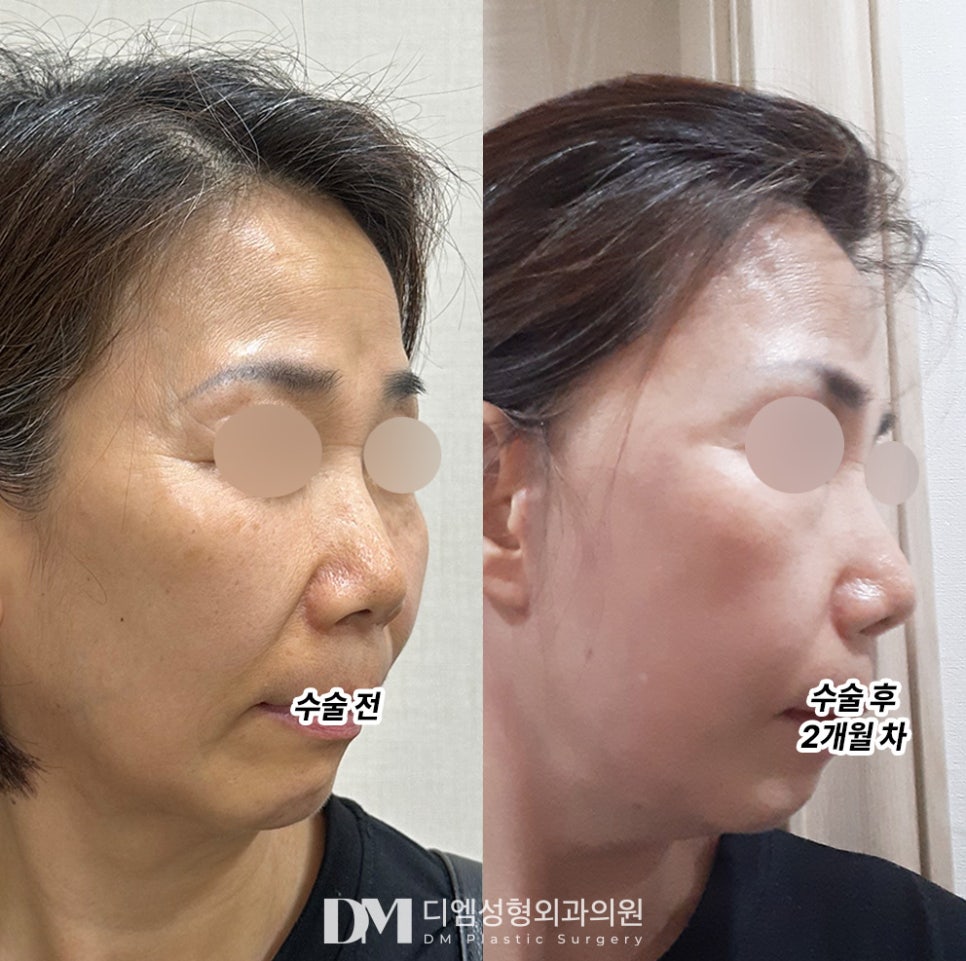 안면거상 후기."얼굴라인이 자연스럽게 살아나 거울 볼 때마다 만족스러워요!" 관련 이미지 2