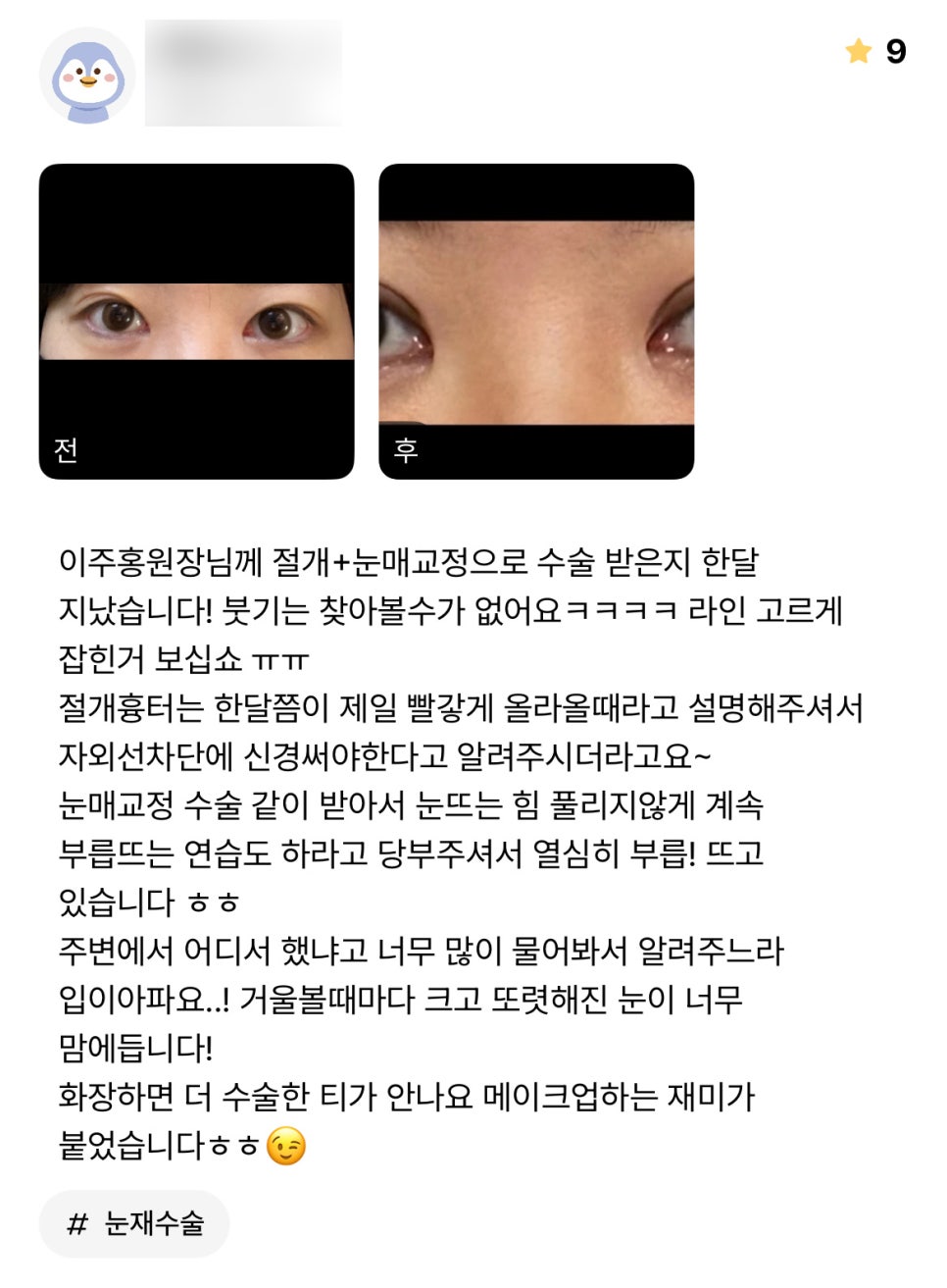 눈재수술 후기."거울 볼 때 마다 크고 또렷해진 눈이 너무 맘에 듭니다!" 관련 이미지 1