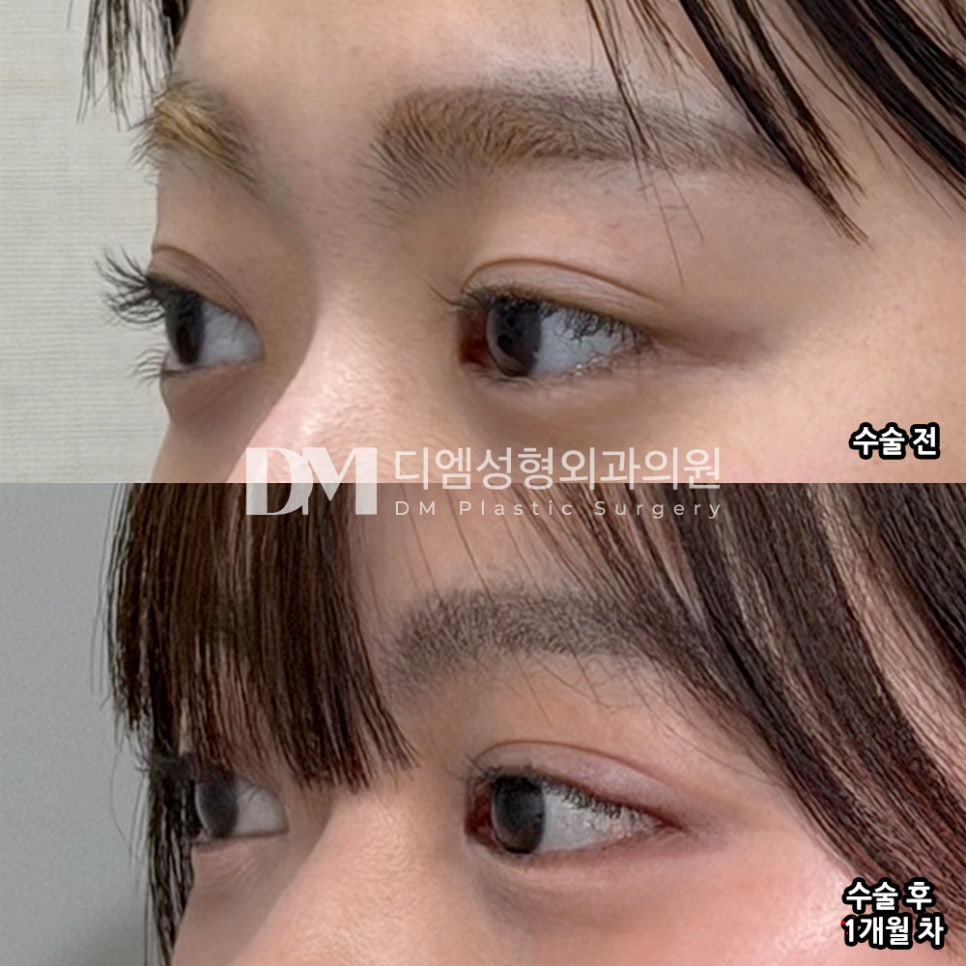DM Ppang Ttim Surgery Review, “I feel more satisfied every time I look in the mirror!” image 3