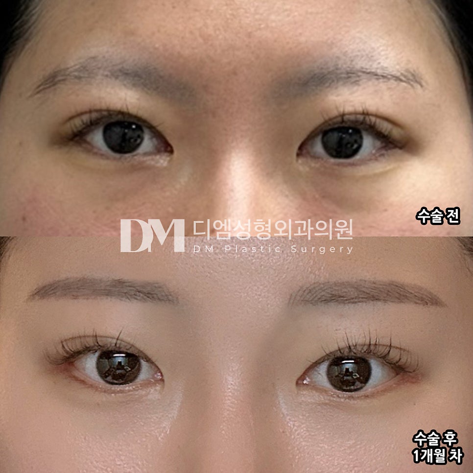 Ppang Eye Corner Surgery Review. "I'm satisfied because it turned out naturally and well!" image 2