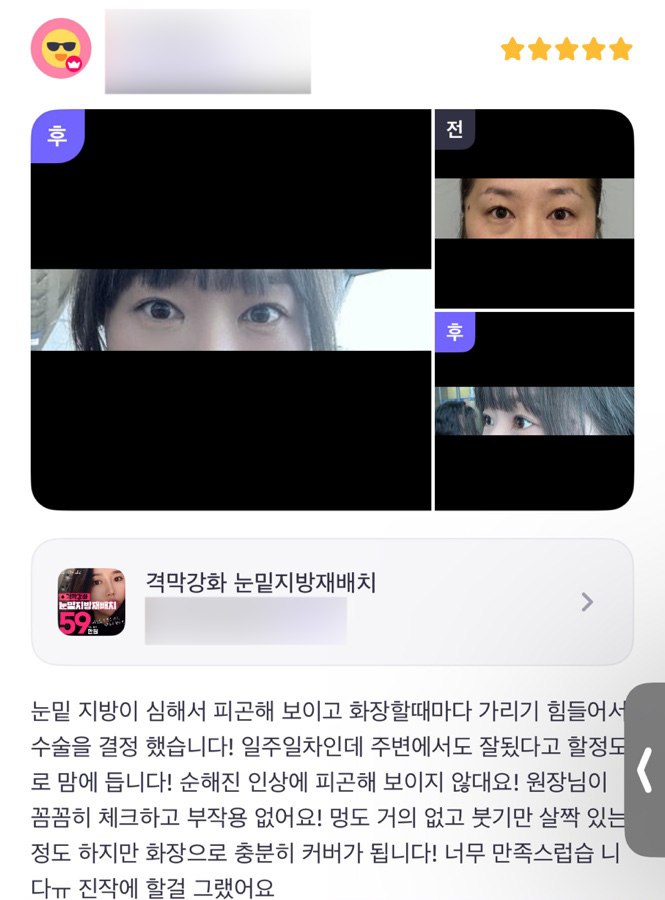 눈성형 후기."순해진 인상에 피곤해보이지도 않는대요 ! 너무 만족스러워요!" 관련 이미지 1