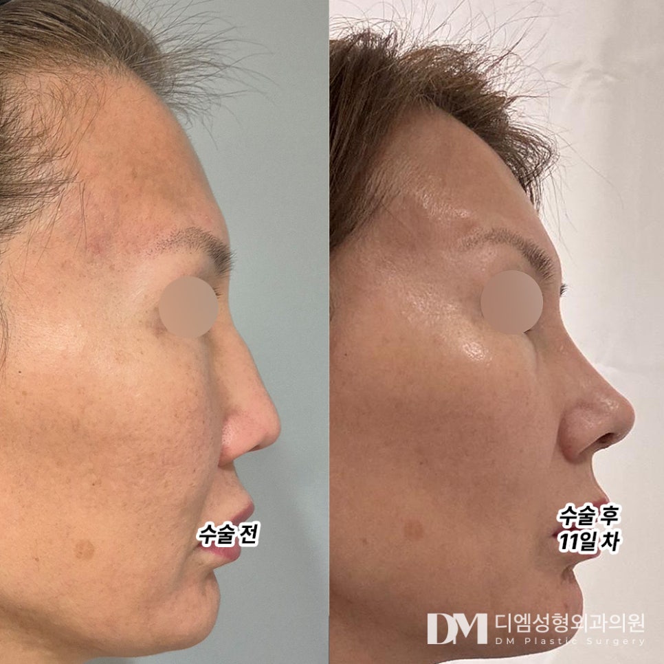 매부리코 성형, 자연스럽게 개선하기 위해서는? 관련 이미지 6