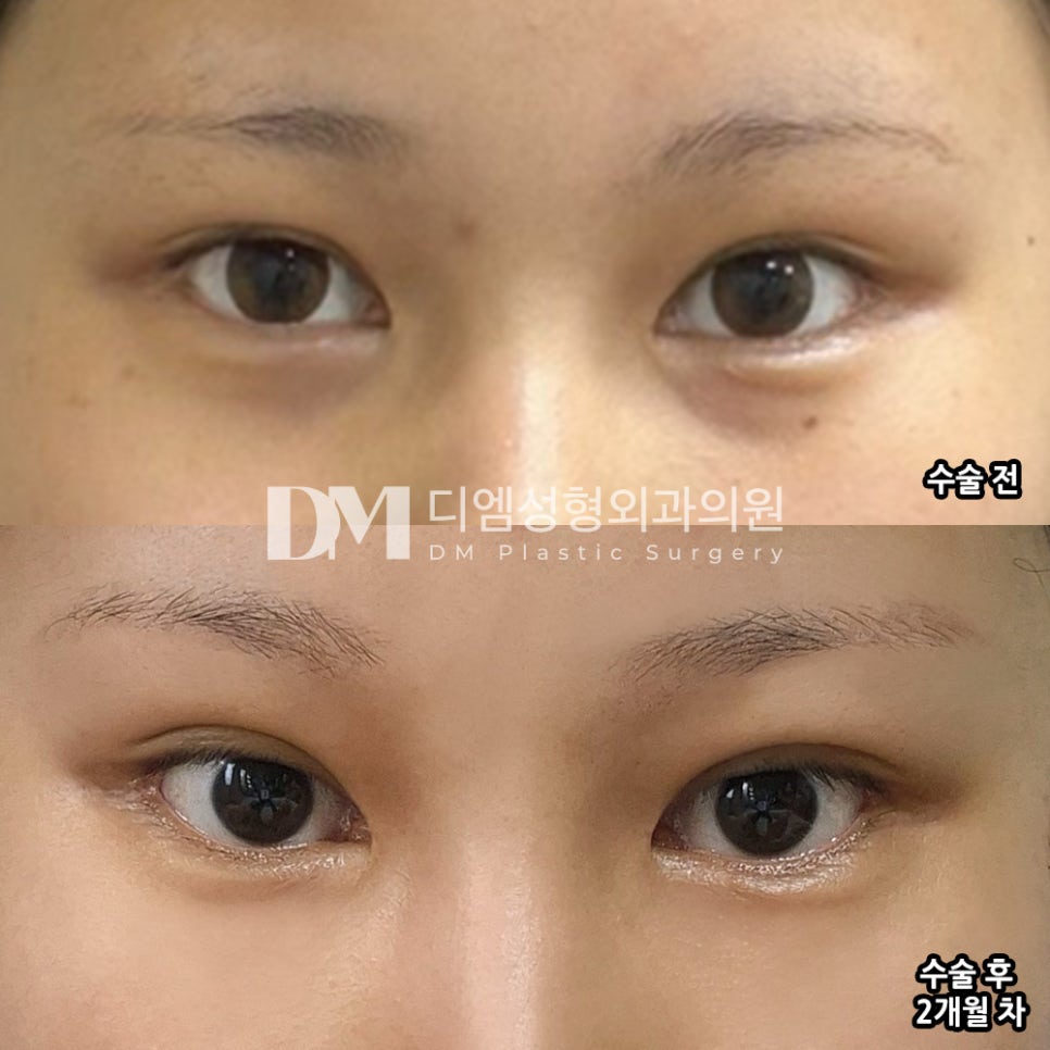 눈재수술 후기."수술 전혀 아프지도 않고 회복도 빨라서 좋았어요!" 관련 이미지 2