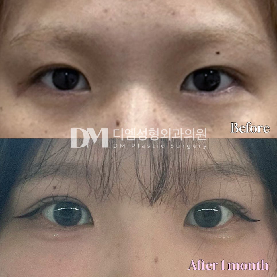 눈재수술 후기."결과 너무 너무 만족해요ㅠㅠ" 관련 이미지 2