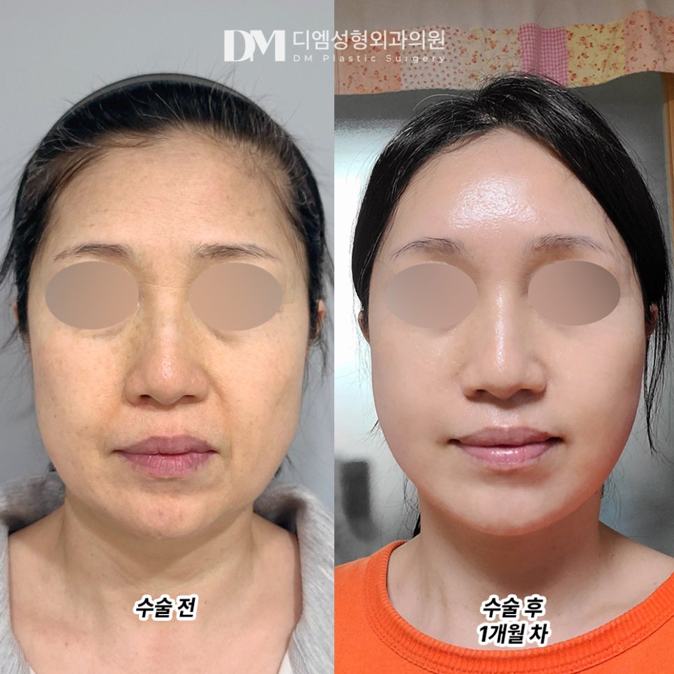 DM Facelift Before-and-After Photos, End the Stress of Deepening Wrinkles and Lost Elasticity! image 2