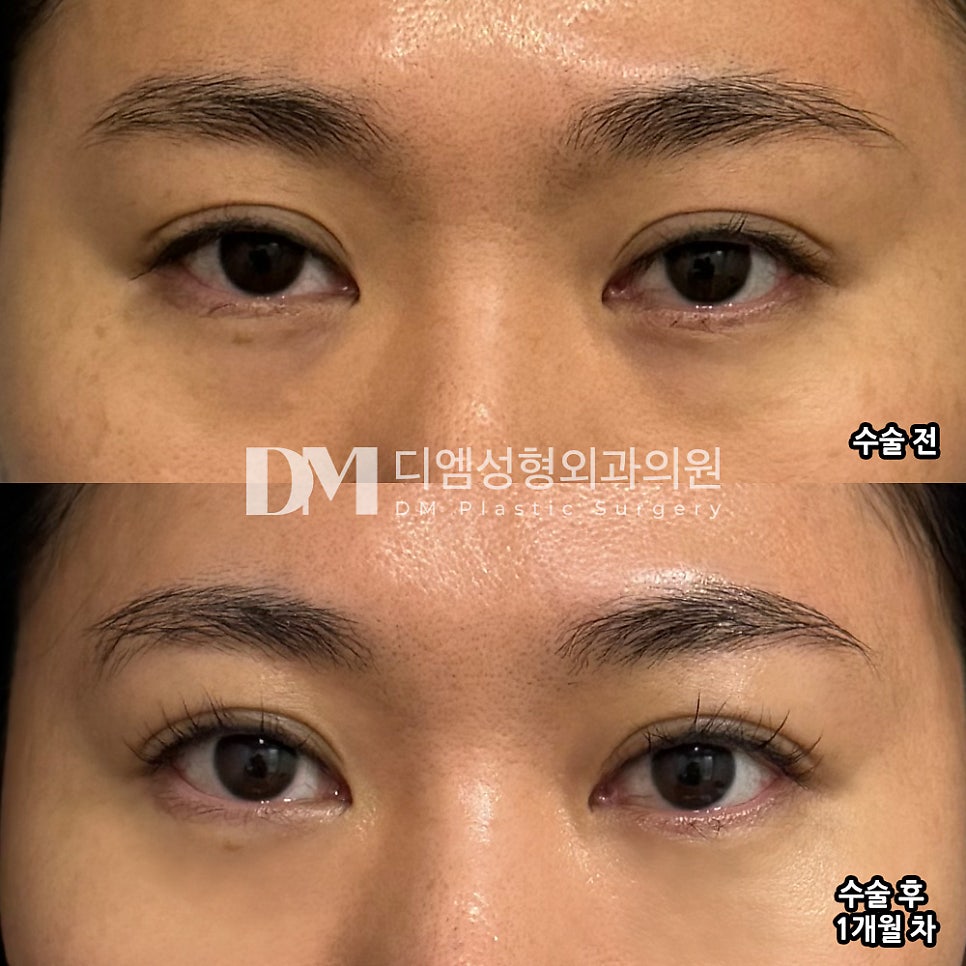 Lower Eyelid Fat Repositioning Review: “People around me said it looks natural and turned out well!” image 2