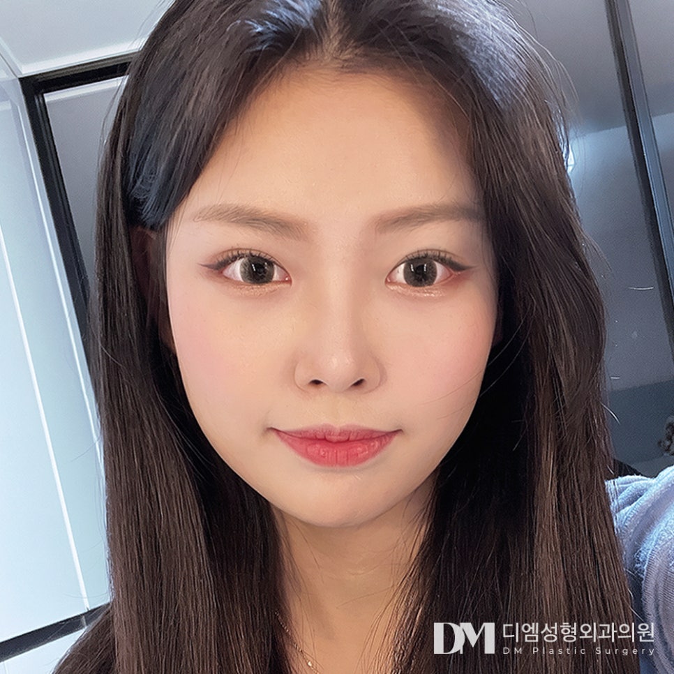 디엠 얼굴지방이식 전후사진, 얼굴에 볼륨을 더하면 생기는 변화 관련 이미지 1