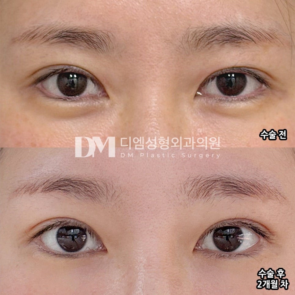 디엠 눈재수술 후기, “맞춤식 상담이어서 만족스러워요!” 관련 이미지 2