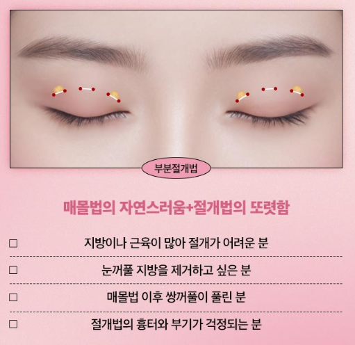 쌍꺼풀수술, 내 눈매에 맞는 자연스러운 라인으로 관련 이미지 8