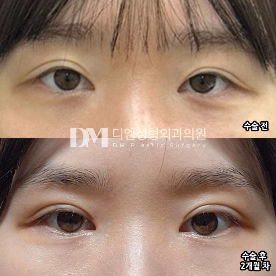 Eyelid Correction, Refreshed and Clear! image 12