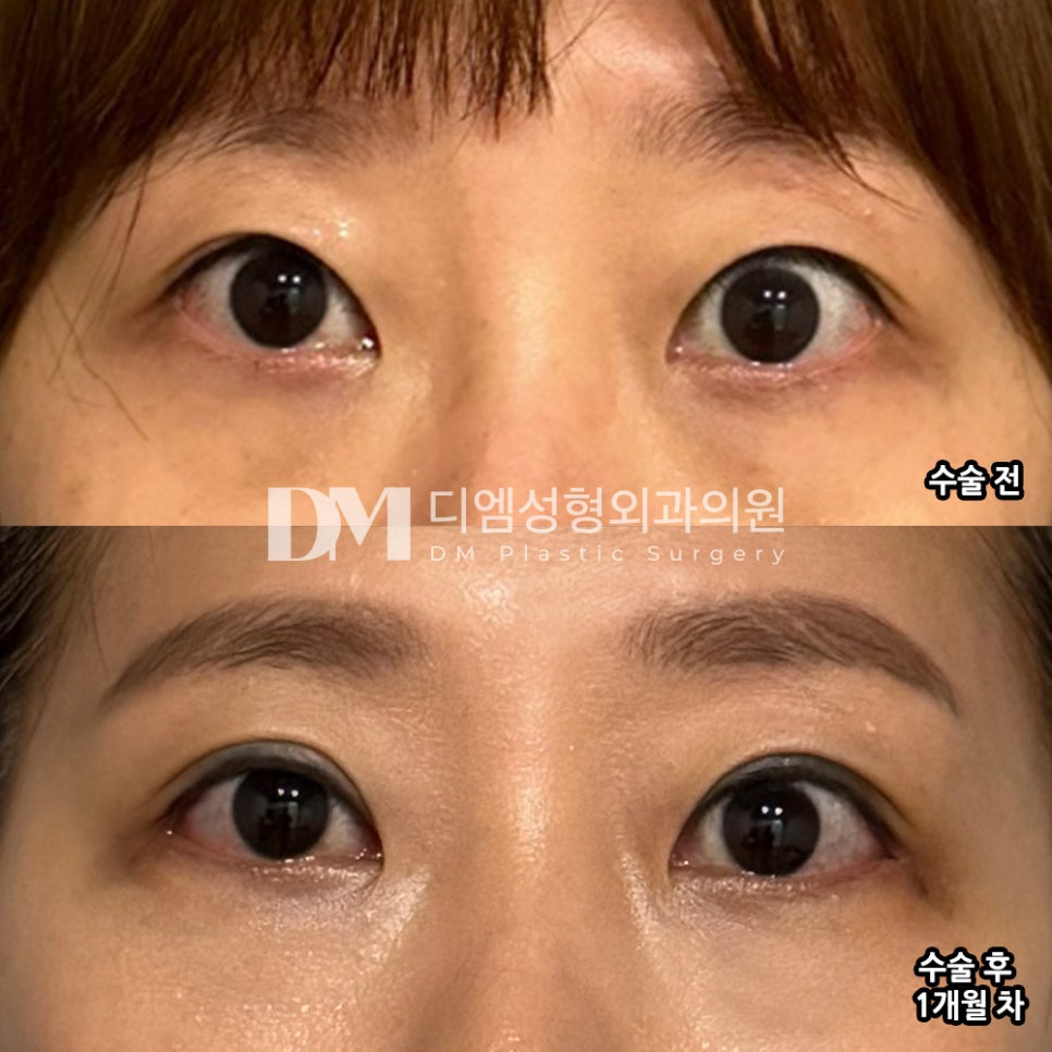 Blepharoplasty Review: "I’m so satisfied, and everyone says I look pretty, so it was a success!" image 2
