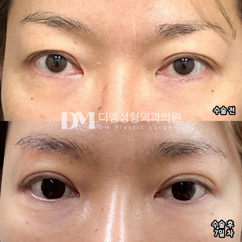 Eyebrow Lift Review. "I’m satisfied that they accurately improved the parts I was worried about!" image 2