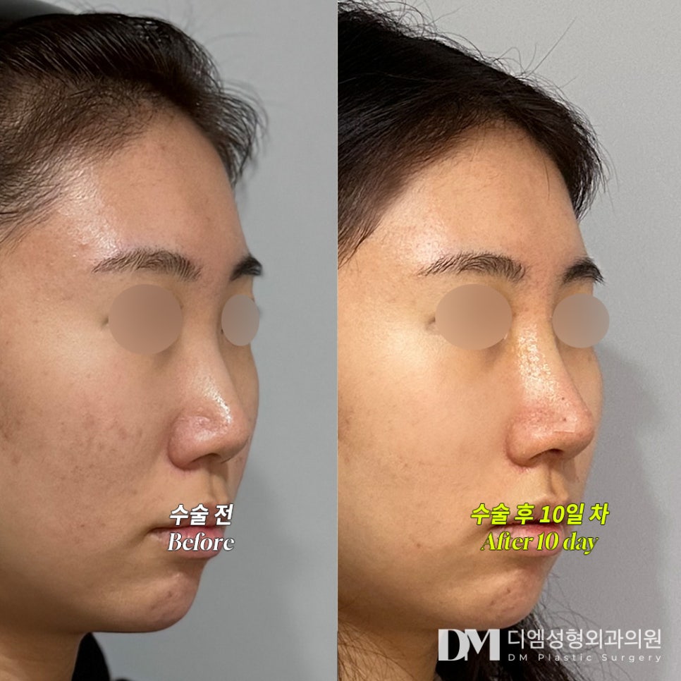 Nose Surgery Review. "So far, I’m satisfied and my excitement keeps growing. I’m glad I decided to get nose surgery!" image 2
