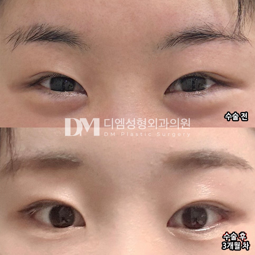 디엠 빵트임 수술후기, &ldquo;눈 크기가 달라져서 너무 좋아요!&rdquo; 관련 이미지 2