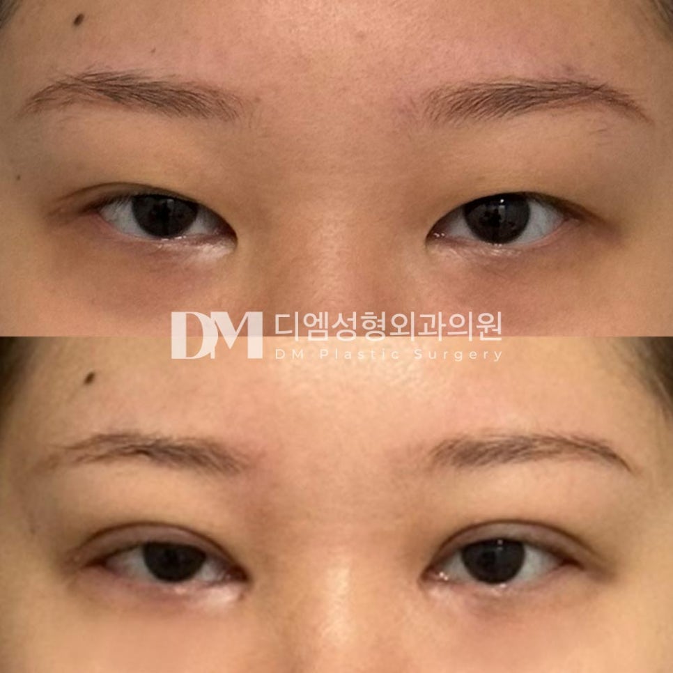 눈재수술 후기."제 눈을 정말 신경써주신다는 생각이 들었어요!" 관련 이미지 2