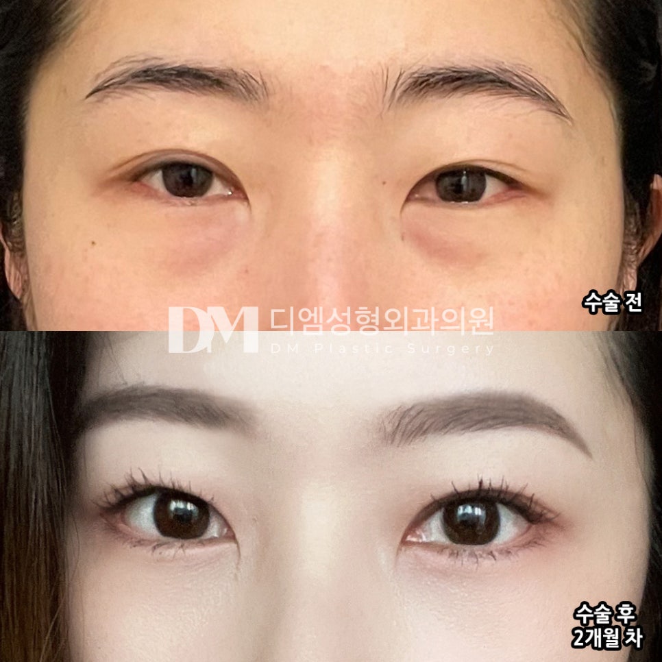 Under-Eye Fat Repositioning: Creating Brighter, More Vibrant Eyes image 6