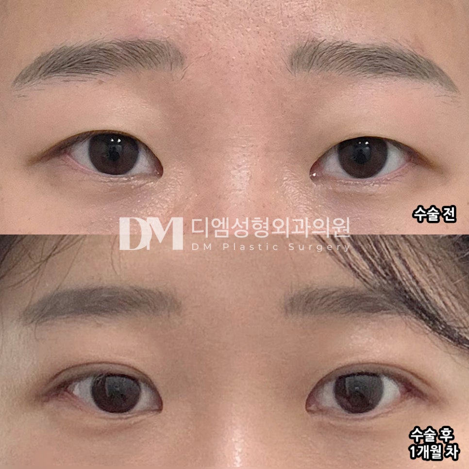 DM Revision Eyelid Surgery/Back-Wing Eye Corner Surgery Review, “The price is the same and there was no excessive consultation!” image 2