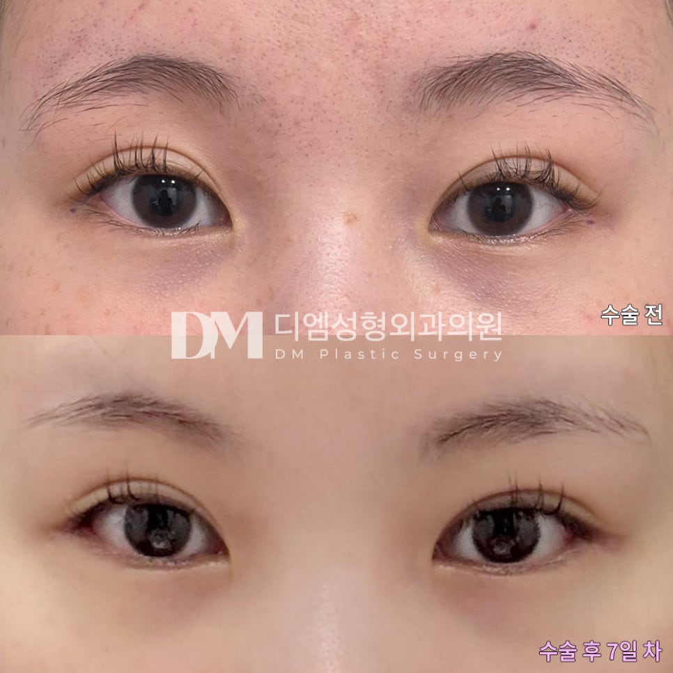 Back-and-Bottom Canthoplasty Review. "I was so glad that everyone explained things kindly and reassured me" image 2