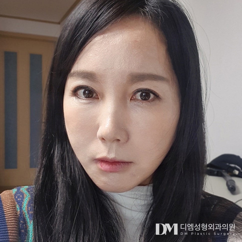 디엠 안면거상 전후사진, 잃어버린 젊음을 다시 찾다! 관련 이미지 1