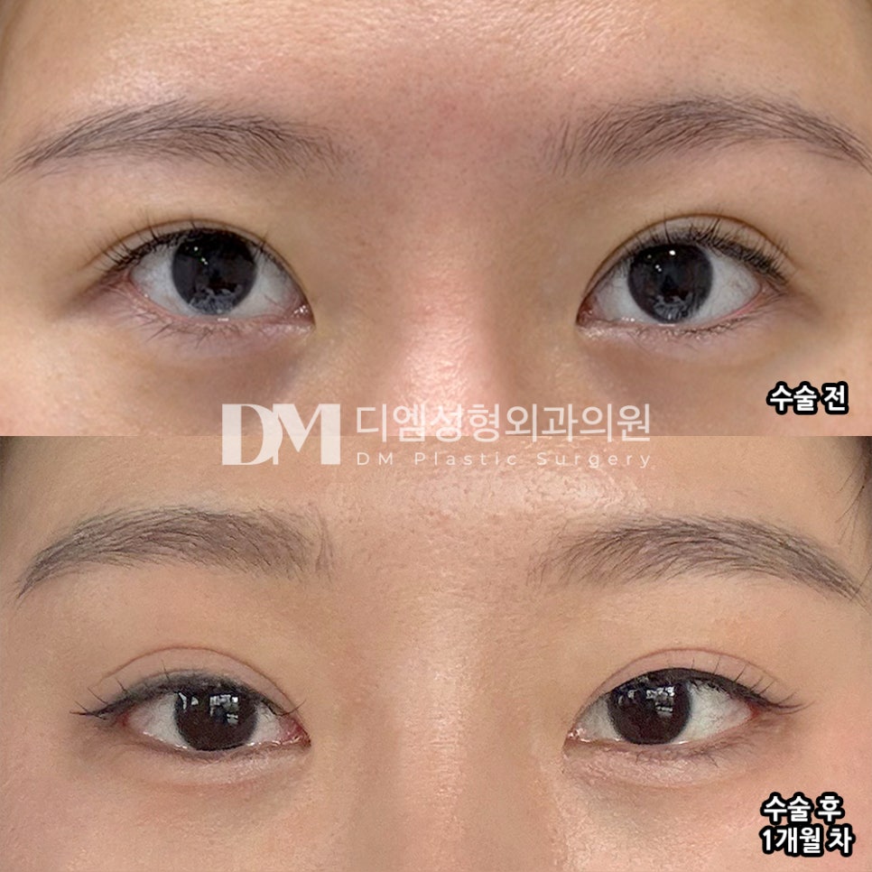 디엠 빵트임 수술후기, &ldquo;결과는 매우 만족스러워요!&rdquo; 관련 이미지 2