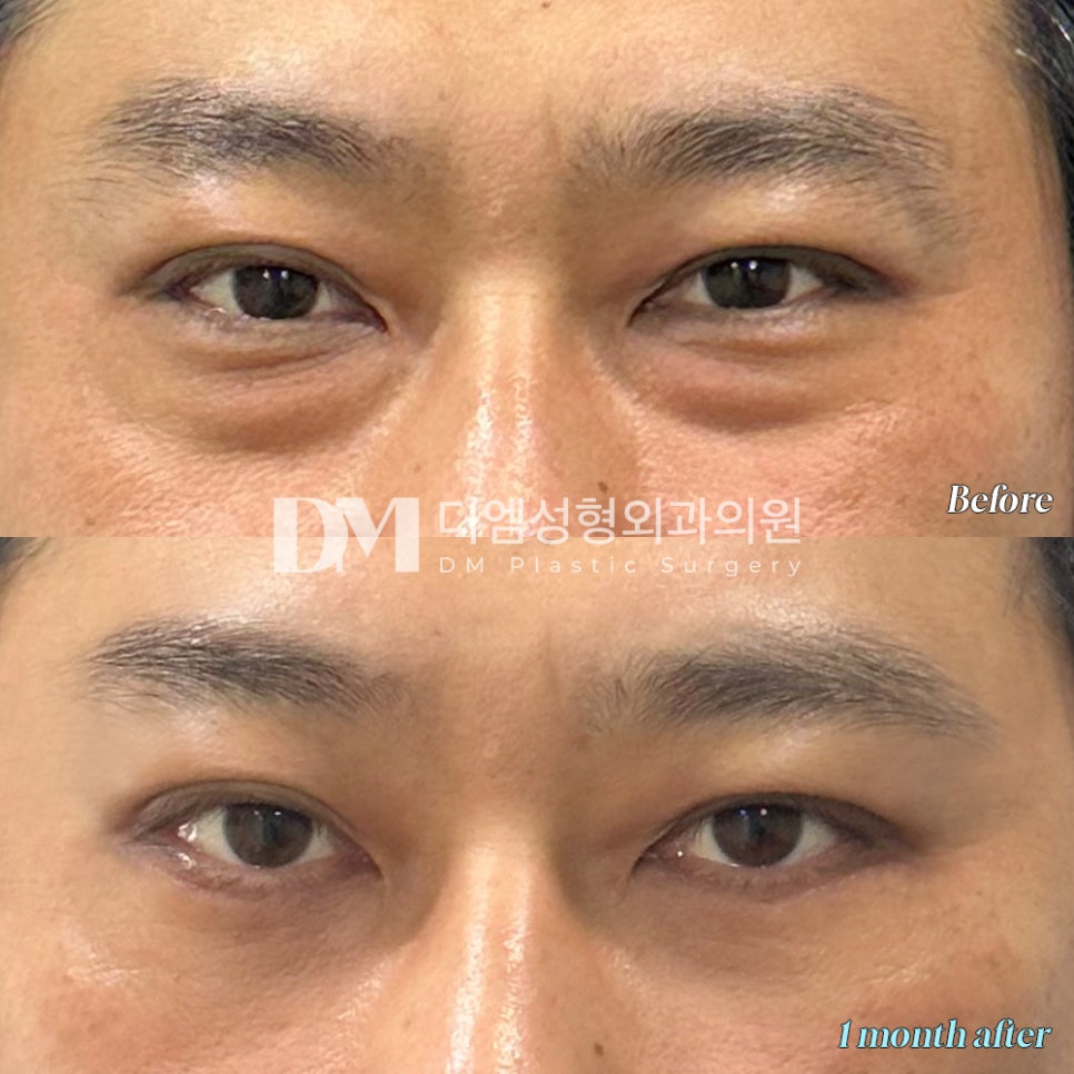 Bulging Under-Eyes Improved with Lower Blepharoplasty for a Clearer Impression! image 7