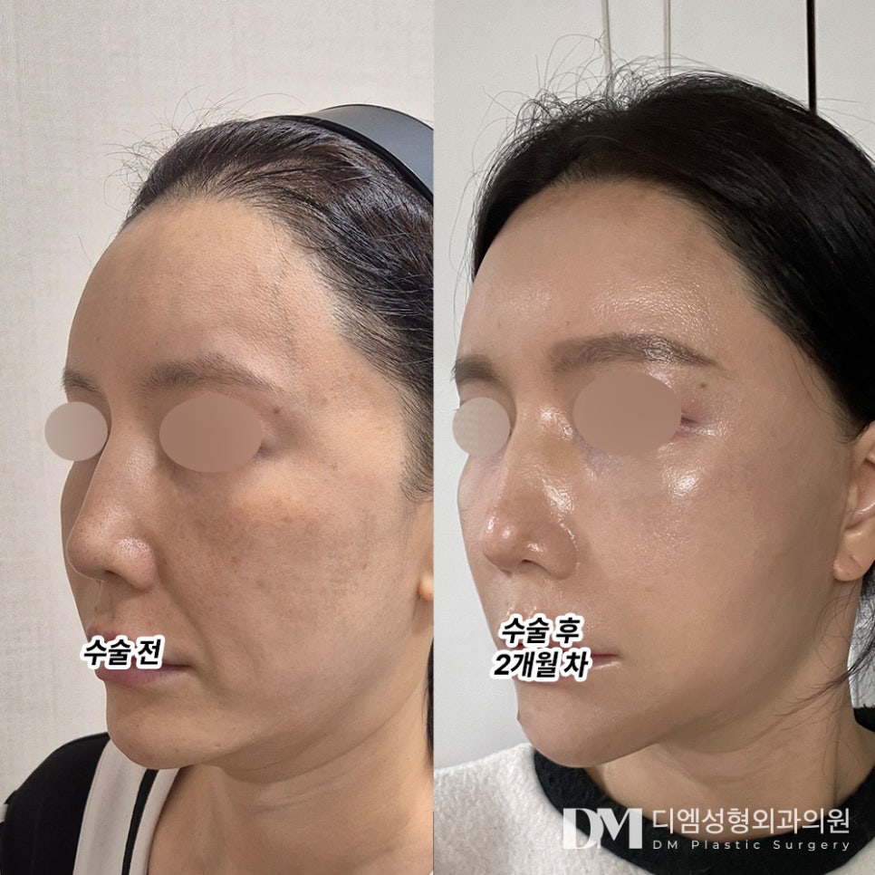 안면거상 후기."안면거상 대만족이에요!" 관련 이미지 2