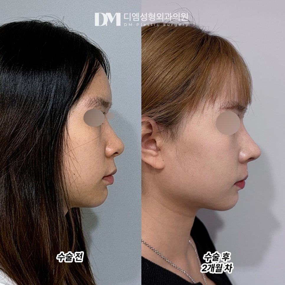 디엠 코성형 후기, “무엇보다 결과에 만족했습니다!” 관련 이미지 3