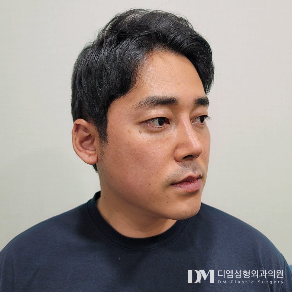 낮은코성형, 자연스럽게 입체감 살리기 관련 이미지 11