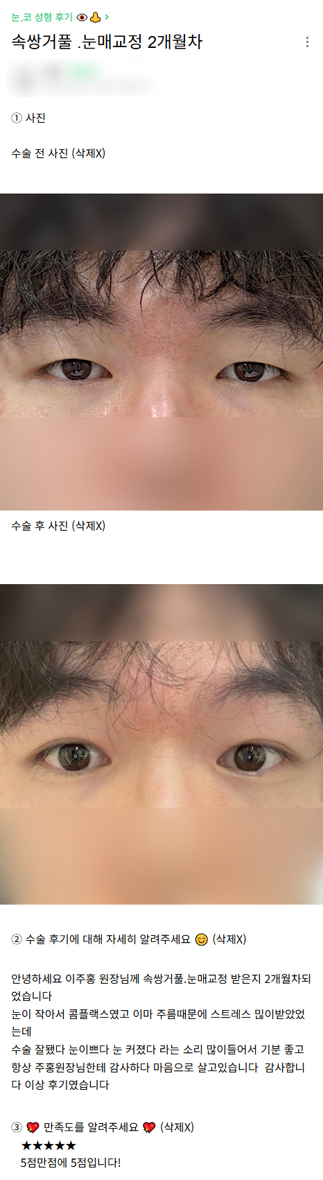 디엠 남자눈매교정/남자눈성형 후기, “눈 예쁘다는 소리 많이 들어서 기분 좋습니다!” 관련 이미지 1