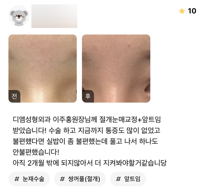 Eye Surgery Review: “There wasn’t much pain, and I wasn’t uncomfortable at all!” image 1