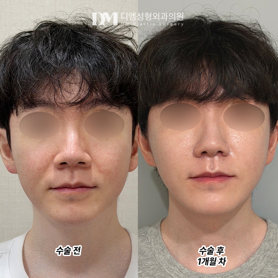 DM Male Facelift Before-and-After Photos: If You Want to Improve Overall Facial Sagging, Take Note! image 2
