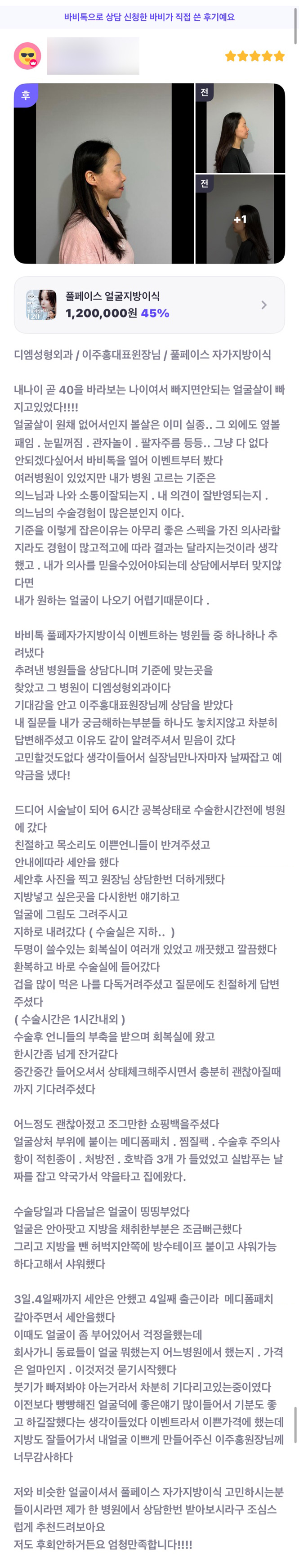 얼굴지방이식 후기."엄청 만족 합니다!!!!" 관련 이미지 1